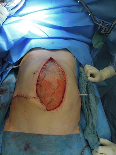 Partial abdominal closure.