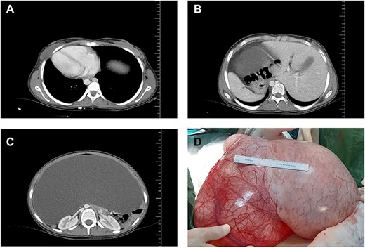 Organ locations (A, B) showing situs inversus totalis and axial (C) and coronal (D) views of the cystic mass on computed tomography.