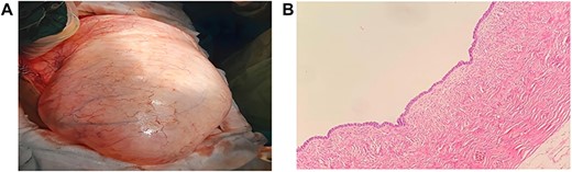 (A) Macroscopic view of the giant cystic mass taken out of the abdominal cavity. (B) The Cyst is lined by ciliated epithelium without significant nuclear atypia, H&E; x10.