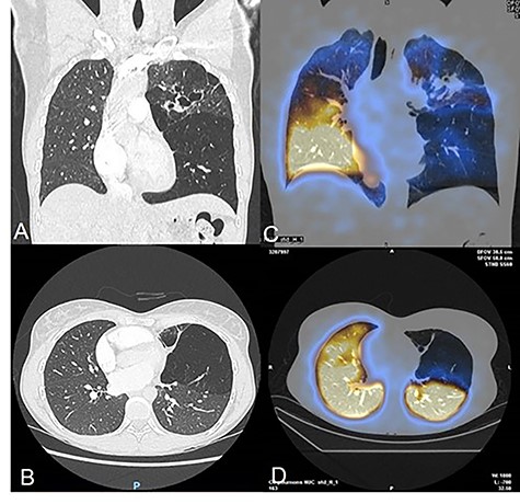 (A–B) Chest CT-scan showing the complex congenital malformation with destruction of the left superior lobe with bronchiectasis and a voluminous bulla of the left lower lobe. (C–D) Perfusion scintigraphy revealing no perfusion of the left upper lobe and bulla of the left lower.