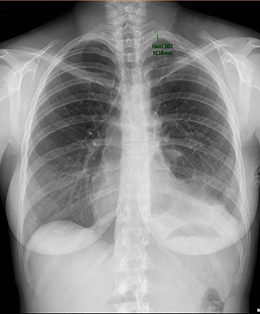 Chest radiography showing small residual pneumothorax after chest tube removal.