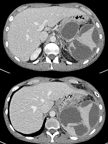 Pancreatic pseudocyst associated with intrasplenic extension and rupture with subcapsular hematoma.