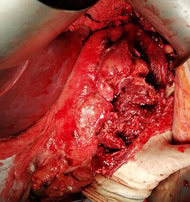 Intraoperative image of the ruptured spleen associated with abundant clots.