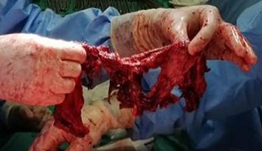 Extracted ruptured splenic parenchyma.