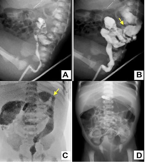 A water-soluble contrast enema image shows characteristic narrowing of the left colon up to the splenic flexure (yellow arrow) (A–C); a transanal tube was inserted into the transverse colon (C); the plain abdominal X-ray of the occluded tube shows dilation of the colon from the transverse colon to the oral side (D).