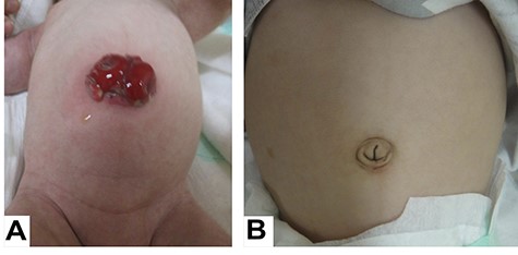 A looped transverse colon stoma was placed in the umbilicus (A); the stoma scar on nabel is inconspicuous (B).