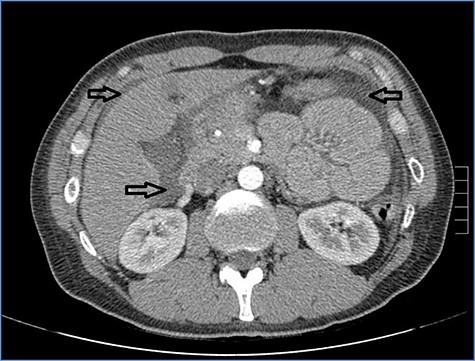 Abdominal CT scan showing diffuse fluid collection (arrows).