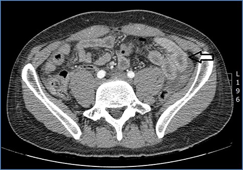 Abdominal CT scan showing distention, bundling and thickening of some small bowel loops in the left quadrant (arrow).