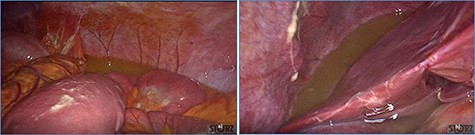 Diffuse exudative fluid and fibrin clots at laparoscopic exploration: (a) left upper quadrant and (b) right upper quadrant.