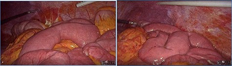 Dilated small bowel loops at laparoscopic exploration: bowel ischemia is evident from the absence of visible vasa recta compared to the adjacent loops (a) 50 cm and (b) 100 cm from the ligament of Treitz.