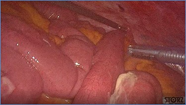 Progressive small bowel revascularization perceived by slow reappearance of vasa recta after peritoneal lavage.