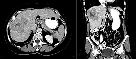 Abdominal ceCT demonstrated an arterially enhancing mass with early washout characteristic of HCC; venous phase axial and coronal images are featured.
