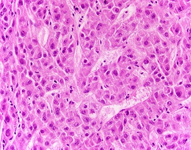 Liver biopsy showed neoplastic cells with cytoplasmic amphophilia, increased nuclear/cytoplasmic ratio and an abnormal trabecular architecture, diagnostic of HCC.