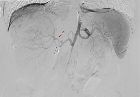 Celiac angiogram demonstrated tumor supply from both the anterior (red arrow) and posterior (blue arrow) divisions of the right hepatic artery; the gastroduodenal artery was coiled for embolic protection.