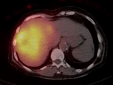 Post-Y-90 Bremsstrahlung SPECT/CT demonstrates uptake predominantly within the main right liver lobe lesion (GTV) with minor uptake into the Segment IVA lesion.