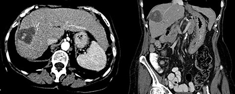 Three month follow-up ceCT demonstrates necrosis and involution of the lesion as well as spontaneously hyperdense material centrally consistent with hemorrhage.