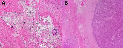 Sections from partial hepatectomy; (A) tumor area of extensive hyalinized fibrosis and glass microspheres; (B) small focus of residual HCC adjacent to fibrosis.
