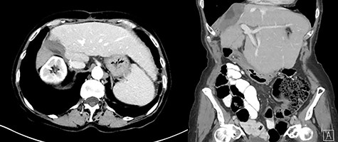 Six-month postoperative ceCT showing no residual tumor; post-surgical changes are seen along the cut edge of the liver status post right hepatectomy.