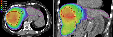 Axial and coronal views of the Y-90 dose distribution; the majority of the uptake is within the GTV with minor uptake in the Segment IVA lesion.