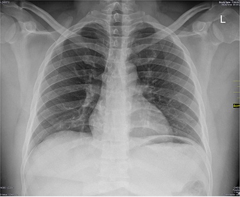Chest X-ray PA view; normal chest X-ray.