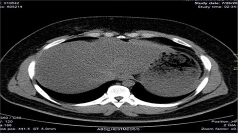 Image showing air lucencies in the right intercostal muscles and subcutaneous tissue around the lower right parasternal region.