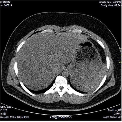 Showing lucent air densities tracking through the right intercostal muscles and abutting on the liver in the epigastrum with associated subcapsular haematoma in the left lobe of the liver.