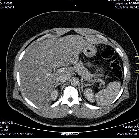Image shows lucent air densities tracking through the subcapsular haematoma in the left lobe of the liver anterior to the pylorus of the stomach.