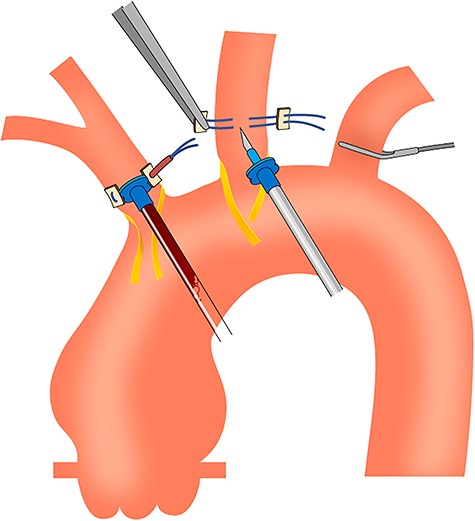 Schema of the simplified isolation technique using aortic root cannulas.