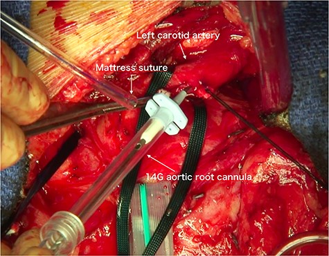 Photograph obtained during surgery. The 14G aortic root cannula is seen puncturing the left common carotid artery.