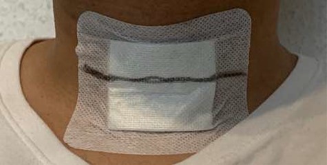 Measuring neck circumference after thyroid surgery.