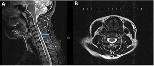 T2-weighted sagittal (A) and axial (B) cervical spine MRI reveals a 4 mm hyperintense area within the spinal cord at the C4–C5 level (arrow) and a disc bulge without spinal cord deformity.