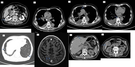 Computed tomography scan showing (A) a 38-mm right renal mass (suspected renal cancer), (B) right hilar lung cancer, with metastasis in the (C and D) bone, (E) lungs, (F) brain and (G) liver.