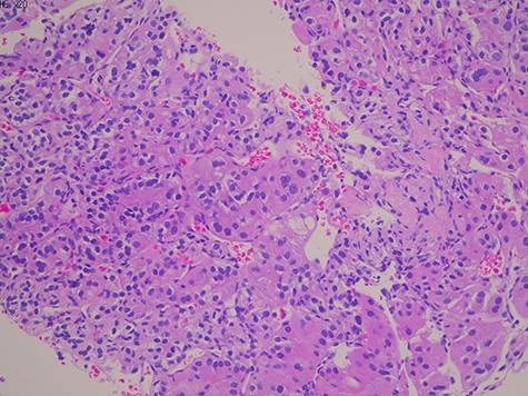 Histology showed a proliferation of large nucleated atypical cells and eosinophilic cytoplasm. Some multinucleated cells with distinct nucleolus are scattered.