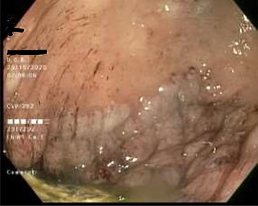 Gastric mucosa seen by endoscopy as nodular, prominent and congested.