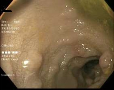 Duodenal mucosa seen by endoscopy shows some erythema and nodularity.