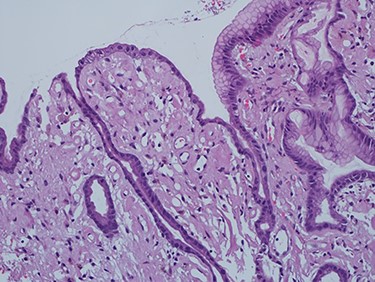 High power of gastric biopsy showing prominent stromal hyalinosis, (H&E x20).