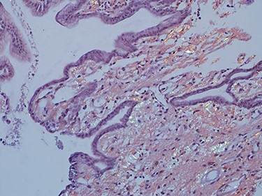 Amyloid stain (Congo red) on gastric biopsy as seen under polarized light showing apple green birefringence.