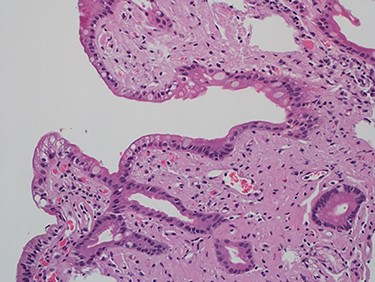 High power of duodenal biopsy showing stromal hyalinosis (H&E x 20).