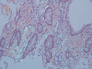 Amyloid stain (Congo red) on duodenal biopsy showing the classic apple green birefringence under polarized light.