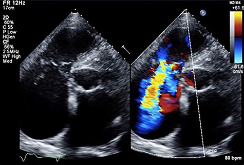 Transthoracic echocardiogram shows severe TR.