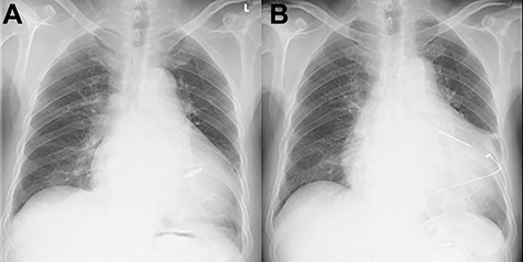 Chest X-ray findings; (A) immediately post-implantation of Micra (B) after tricuspid valve repair and implanted epicardial PM system.