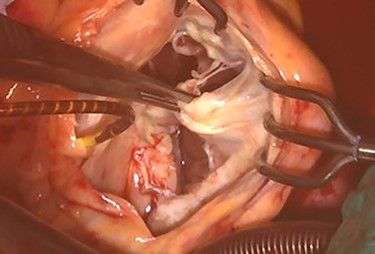 Intraoperative photograph; septal and posterior leaflet of tricuspid valve are severely damaged.