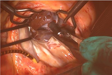 Intraoperative photograph; Micra was retrieved under direct vision.