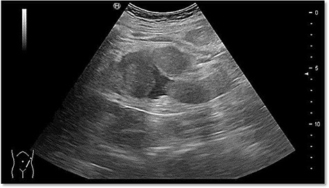 Abdominal sonography in the emergency department with free fluid on the left hemiabdomen.