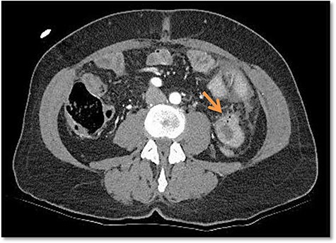 Free air bubbles on the CT scan in the emergency department.