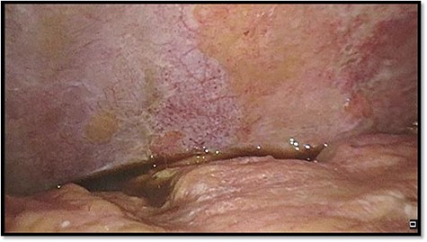 Left upper quadrant during diagnostic laparoscopy.