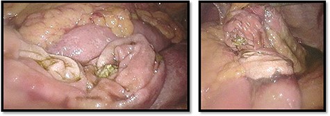 Nearby total circumferential perforation of the small intestine.