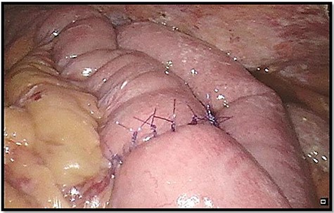 Re-anastomosis of small intestine.