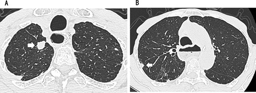 CT showing a circular nodule measuring 1.4 cm in the S1 apex of the right upper lobe (A) and a nodule measuring 0.9 cm outside S2 (B).
