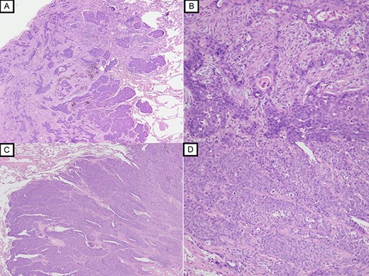Histopathological examination with HE staining revealing squamous cell carcinoma in S1 nodule (original magnification ×20 (A), ×100 (B)); histopathological examination with HE staining revealing poorly differentiated squamous cell carcinoma in S2 nodule (original magnification ×20 (C), ×100 (D)).